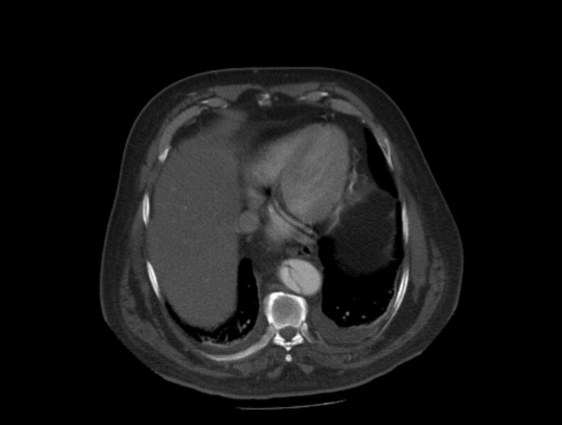 File:Aortic dissection (Radiopaedia 28802-29105 A 32).jpg