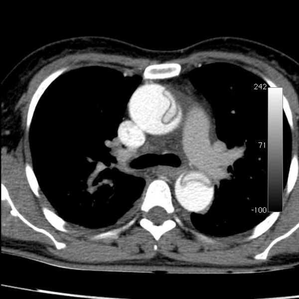 File:Aortic dissection - Stanford type A (Radiopaedia 29247-29659 A 30).jpg
