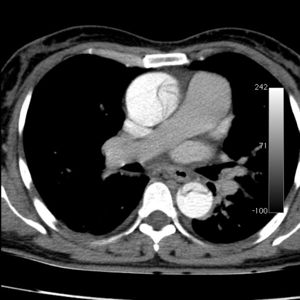File:Aortic dissection - Stanford type A (Radiopaedia 29247-29659 A 37).jpg