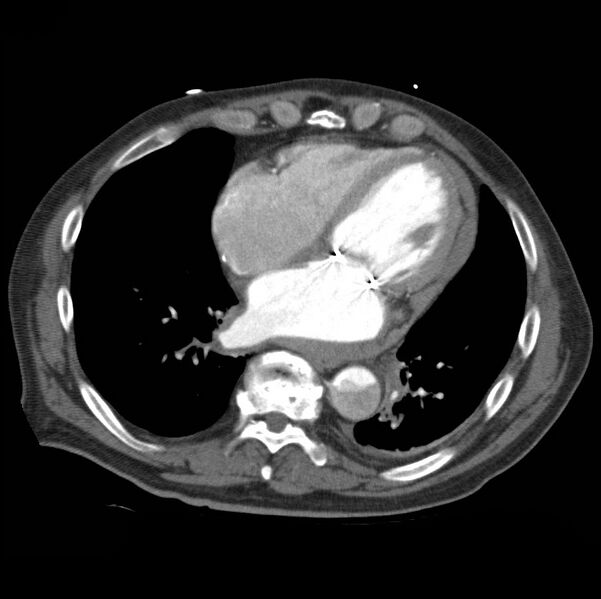 File:Aortic dissection with rupture into pericardium (Radiopaedia 12384-12647 A 38).jpg