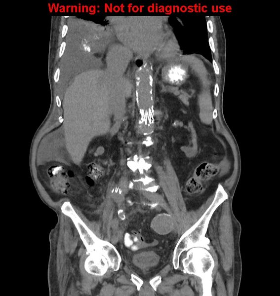 File:Aortic graft infection (Radiopaedia 44979-48907 non-contrast 28).jpg