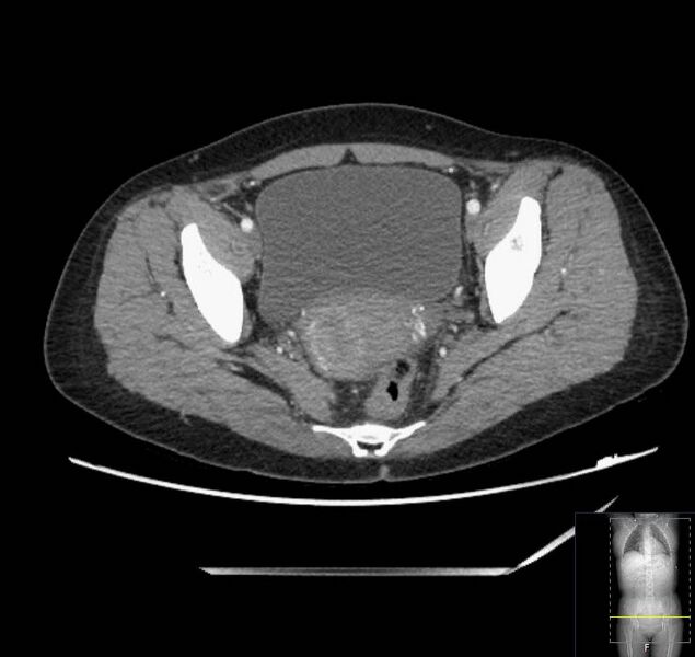 File:Appendicitis (CT angiogram) (Radiopaedia 154713-127660 Axial 40).jpg