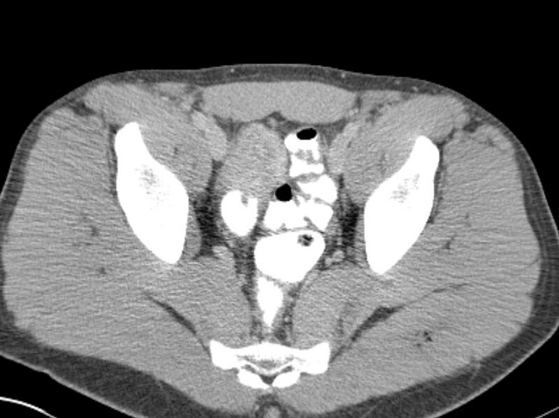 File:Appendicitis and incidental foregut duplication cyst (Radiopaedia 52962-58916 A 88).jpg