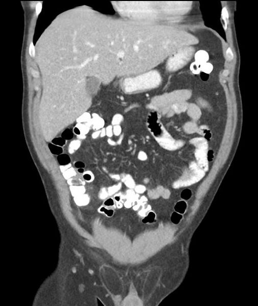 File:Appendicitis with cecal bar sign (Radiopaedia 31878-32830 A 22).jpg