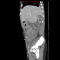 Appendicitis with phlegmon (Radiopaedia 9358-10046 F 12).jpg
