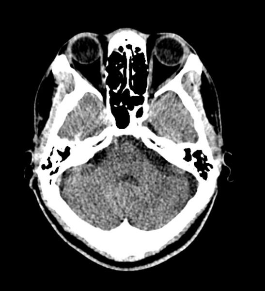 File:Arachnoid cyst of the ambient cistern (Radiopaedia 81301-94986 Axial non-contrast 18).jpg