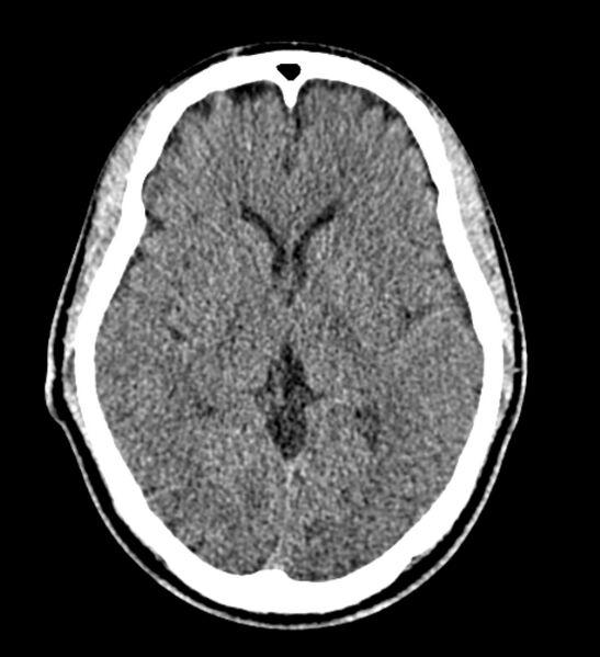 File:Arachnoid cyst of the ambient cistern (Radiopaedia 81301-94986 Axial non-contrast 36).jpg