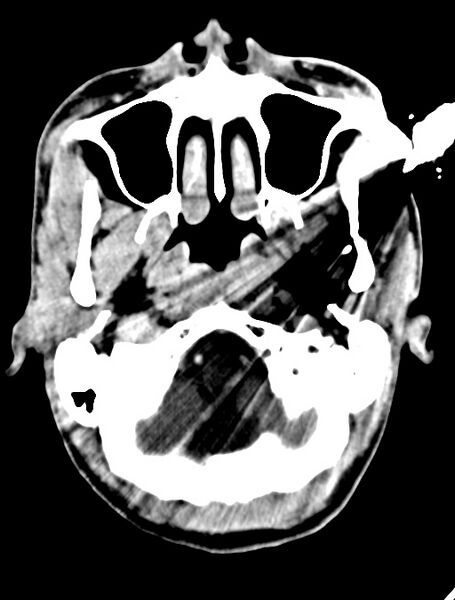 File:Arrow injury to the face (Radiopaedia 73267-84011 Axial C+ delayed 33).jpg
