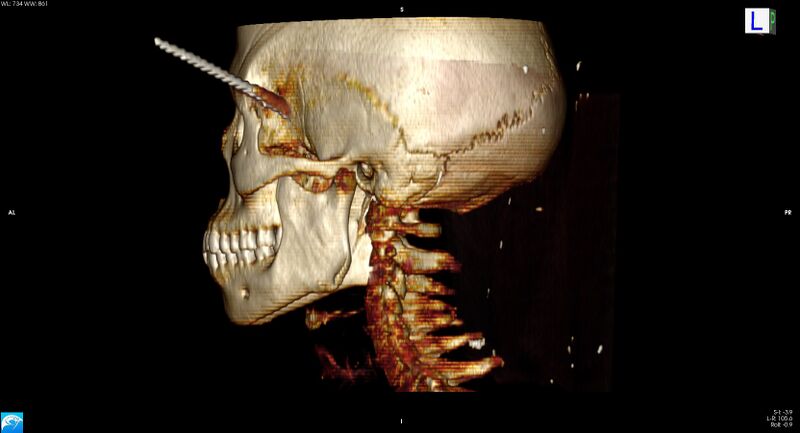 File:Arrow injury to the head (Radiopaedia 75266-86388 3D horizontal 25).jpg