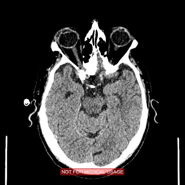 File:Artery of Percheron infarction (Radiopaedia 28679-28967 Axial non-contrast 44).jpg
