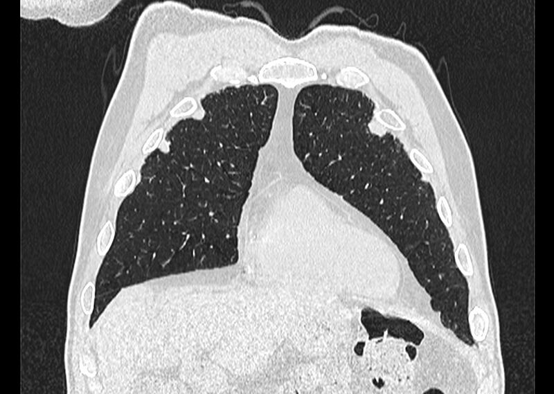 File:Asbestos pleural placques (Radiopaedia 57905-64872 Coronal lung window 52).jpg