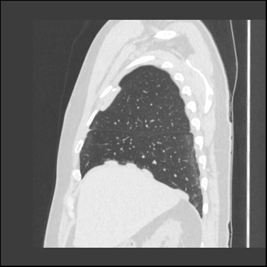 Asbestosis (Radiopaedia 45002-48961 Sagittal lung window 108).jpg