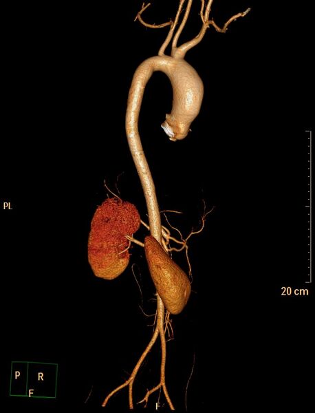 File:Ascending aortic pseudoaneurysm (Radiopaedia 28638-28910 D 11).jpg