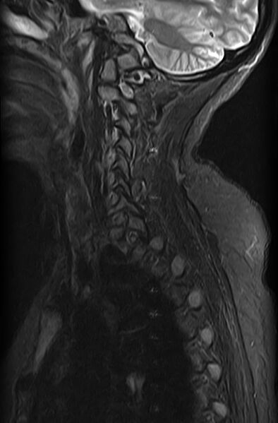 File:Astrocytoma - spinal cord (Radiopaedia 69769-79758 Sagittal STIR 3).jpg