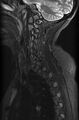 Astrocytoma - spinal cord (Radiopaedia 69769-79758 Sagittal STIR 3).jpg