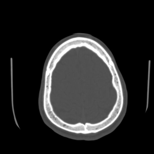 File:Asymptomatic occipital spur (Radiopaedia 87753-104201 Axial bone window 178).jpg