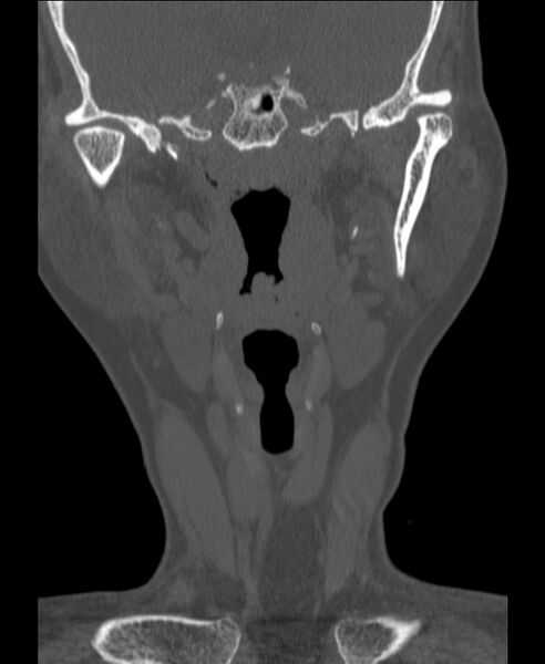 File:Atlanto-occipital assimilation with basilar invagination (Radiopaedia 70122-80188 Coronal bone window 2).jpg