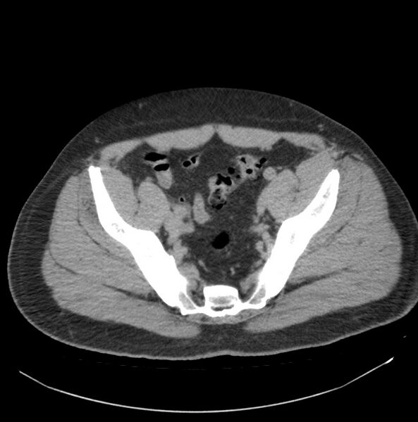 File:Atrophic kidney due to severe chronic obstructive hydronephrosis (Radiopaedia 40828-43474 Axial non-contrast 37).jpg