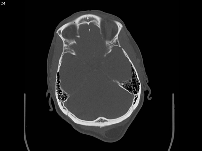 Atypical meningioma - intraosseous (Radiopaedia 64915-73867 Axial C+ bone window 24).jpg