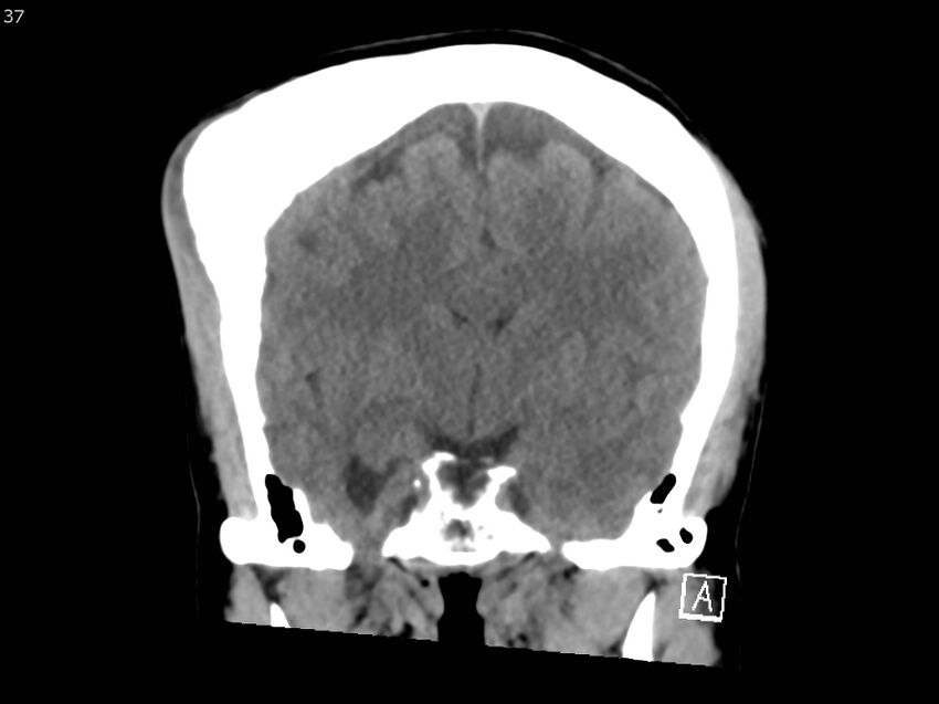 Atypical meningioma - intraosseous (Radiopaedia 64915-73867 B 36).jpg