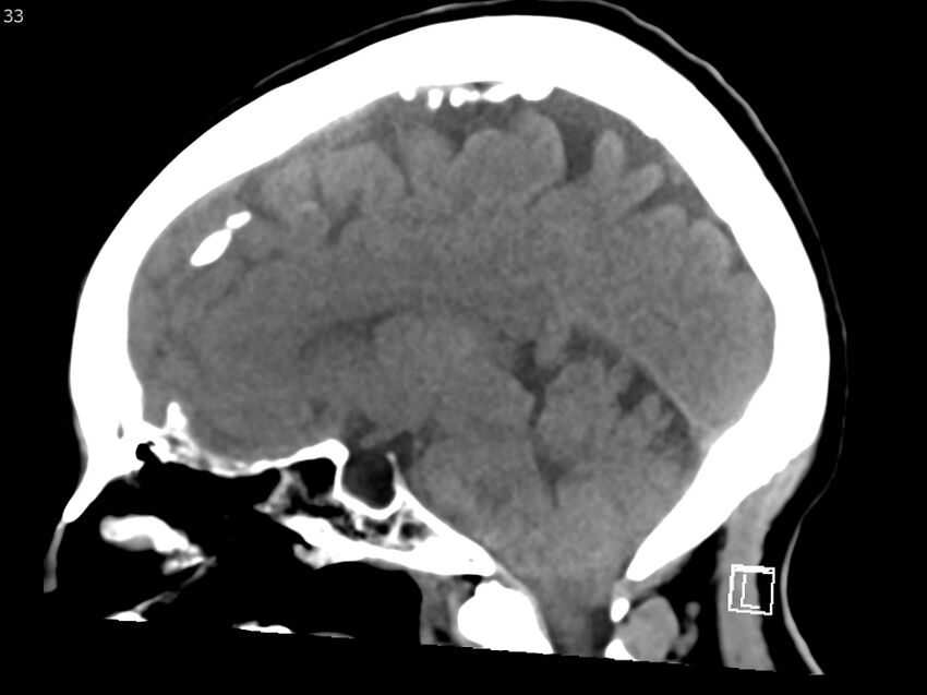 Atypical meningioma - intraosseous (Radiopaedia 64915-73867 C 31).jpg