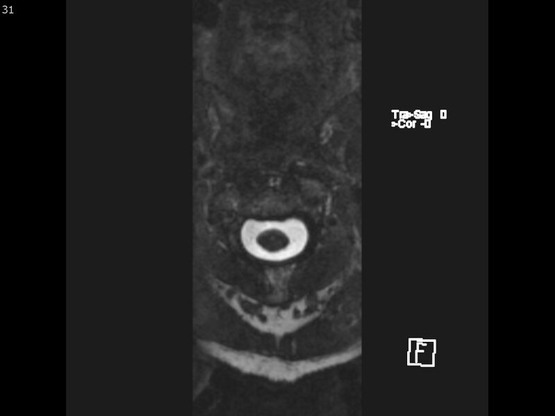 File:Atypical meningioma - intraosseous (Radiopaedia 64915-74572 Axial CISS 31).jpg