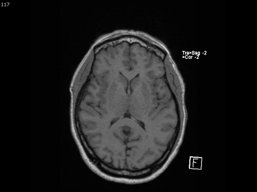 Atypical meningioma - intraosseous (Radiopaedia 64915-74572 Axial T1 117).jpg