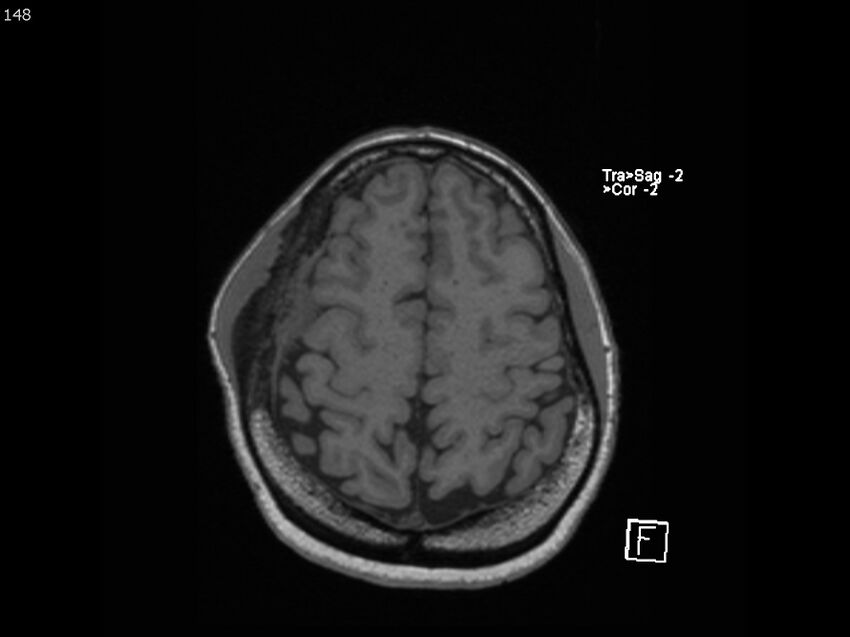 Atypical meningioma - intraosseous (Radiopaedia 64915-74572 Axial T1 148).jpg