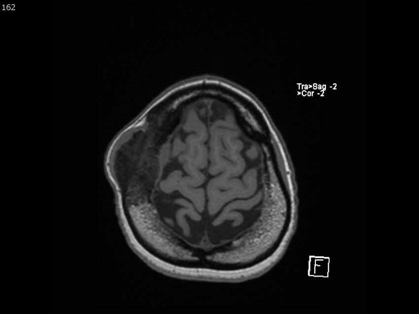 Atypical meningioma - intraosseous (Radiopaedia 64915-74572 Axial T1 162).jpg