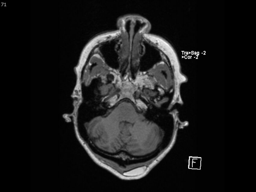 Atypical meningioma - intraosseous (Radiopaedia 64915-74572 Axial T1 71).jpg
