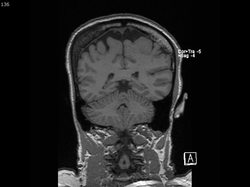 File:Atypical meningioma - intraosseous (Radiopaedia 64915-74572 Coronal T1 136).jpg