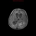 Atypical teratoid rhabdoid tumor (Radiopaedia 10712-11183 Axial FLAIR 8).jpg
