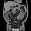 Autosomal dominant polycystic kidney disease (Radiopaedia 36539-38101 C 28).jpg