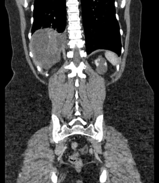 File:Autosomal dominant polycystic kidney disease (Radiopaedia 57124-64017 B 62).jpg
