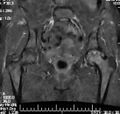 Avascular necrosis of hip (Radiopaedia 10061-10601 Coronal STIR 1).jpg
