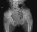 Avascular necrosis of the hip (Radiopaedia 29563-30066 Frontal 1).jpg