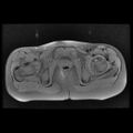 Avascular necrosis of the hip (Radiopaedia 29563-30067 Axial T1 fat sat 11).jpg