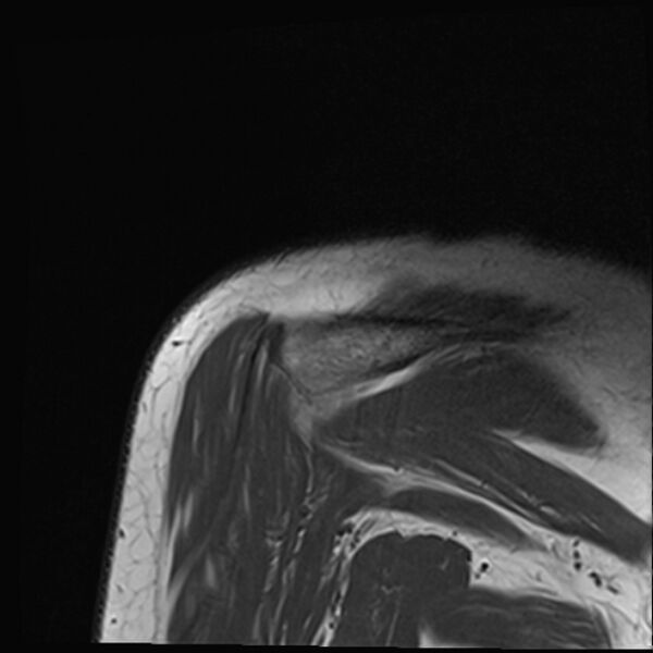 File:Avulsion fracture - greater tuberosity of humerus (Radiopaedia 71216-81515 Coronal T1 3).jpg