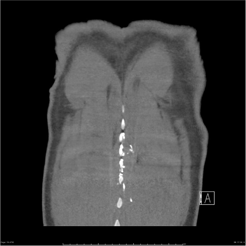 Azygos venous system anatomy (CT pulmonary angiography) (Radiopaedia 25928-26077 Coronal C+ CTPA 76).jpg