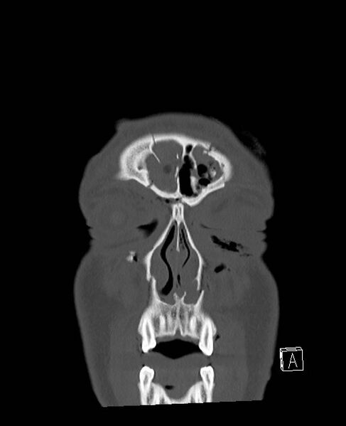 File:Base of skull fracture with bilateral Le Fort fractures (Radiopaedia 47094-51638 Coronal bone window 87).jpg