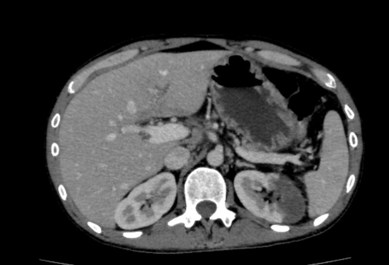 File:Behçet's disease- abdominal vasculitis (Radiopaedia 55955-62570 A 18).jpg