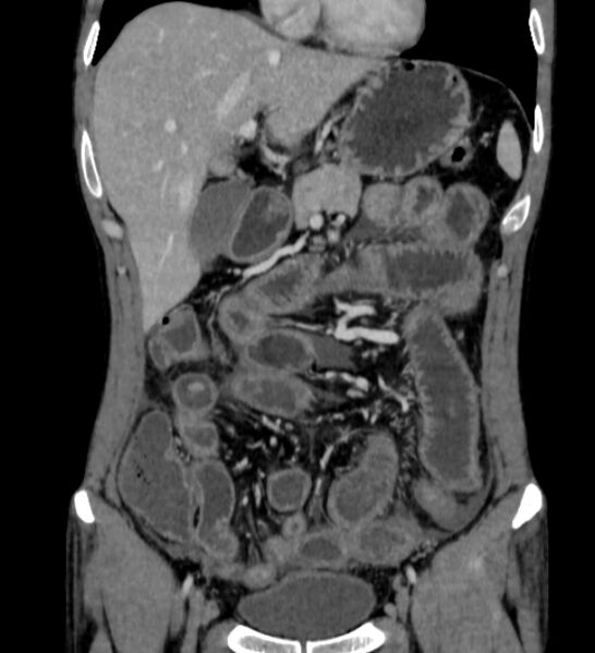 File:Behçet's disease- abdominal vasculitis (Radiopaedia 55955-62570 B 17).jpg