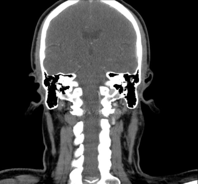File:Benign mixed salivary tumor of the parotid gland (Radiopaedia 35261-36792 B 22).jpg