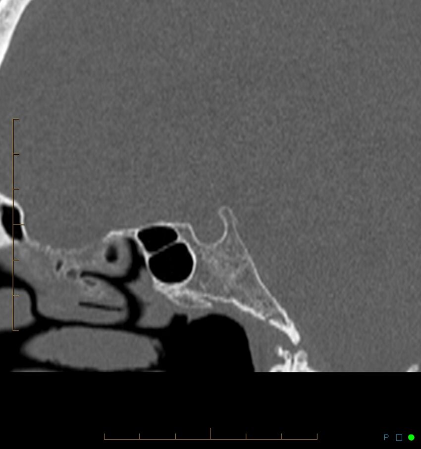 Benign notochordal cell tumor (probable) (Radiopaedia 65475-74546 Sagittal bone window 19).jpg