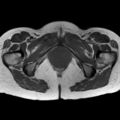 Bicornuate uterus (Radiopaedia 61974-70046 Axial T1 41).jpg