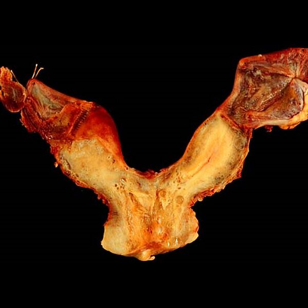 File:Bicornuate uterus (gross pathology) (Radiopaedia 9718).jpg