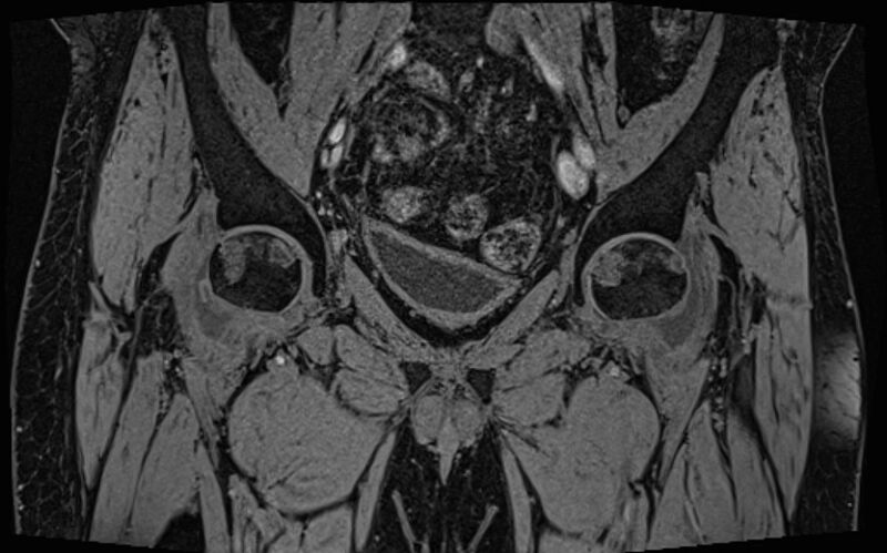 File:Bilateral avascular necrosis of femoral head (Radiopaedia 77116-89078 Coronal T2 we 58).jpg