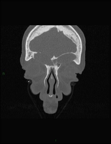 File:Bilateral frontal mucoceles (Radiopaedia 82352-96454 Coronal 70).jpg