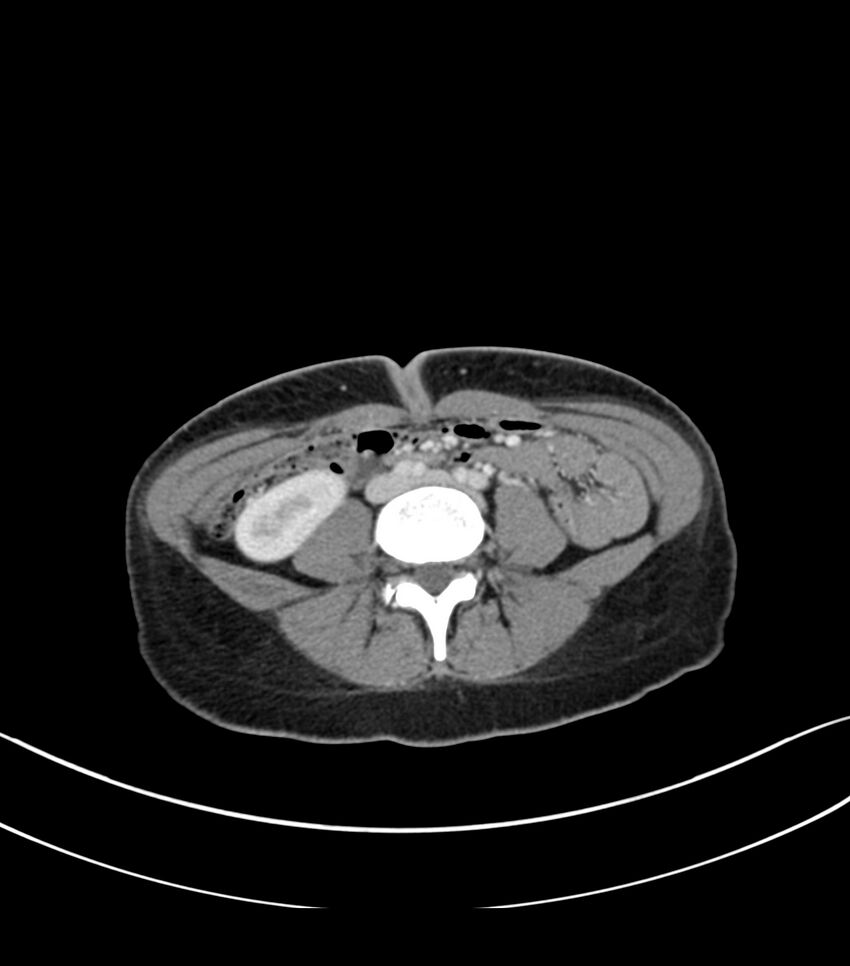 Bilateral kidney malrotation (Radiopaedia 72227-82749 A 42).jpg