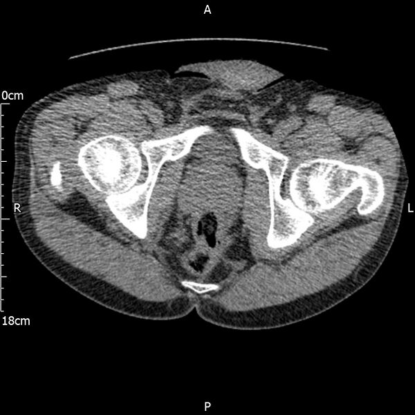File:Bilateral medullary nephrocalcinosis with ureteric calculi (Radiopaedia 71269-81569 Axial non-contrast 131).jpg